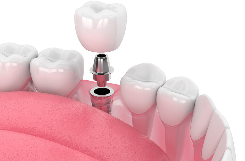 Watsonville wellness center dental implants