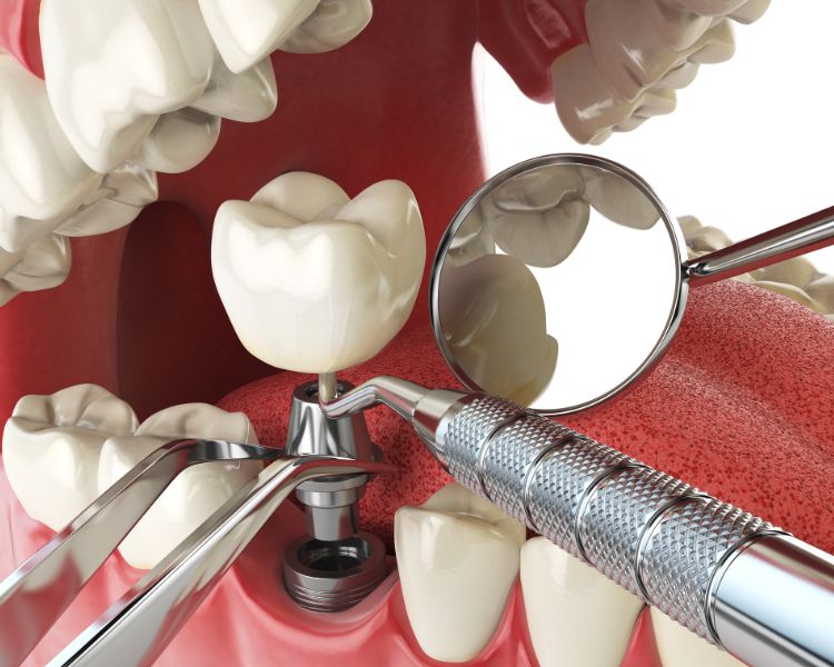 Frequently Asked Questions about Dental Implants