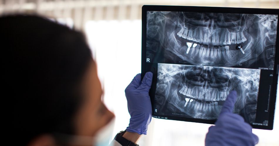 Watsonville wellness center dental implants xray