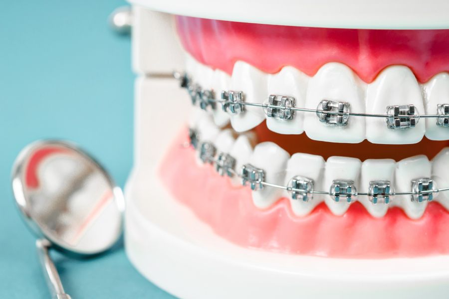 Traditional Braces in Watsonville Image