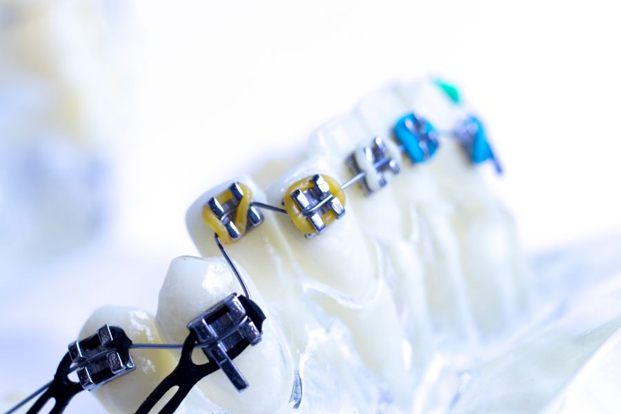 Traditional Braces Image