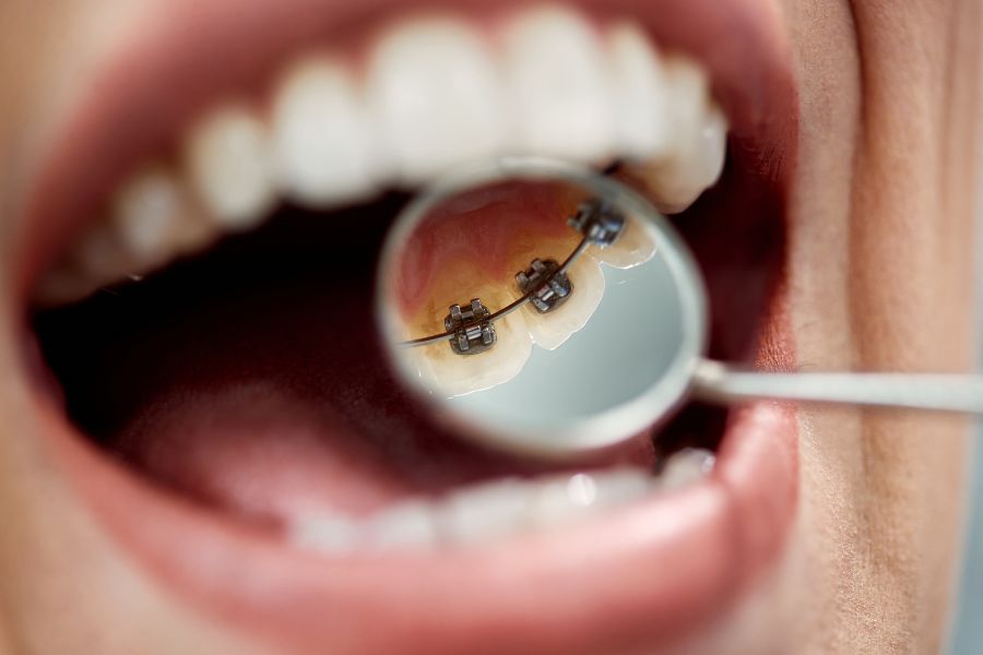 Lingual Braces in Watsonville Image